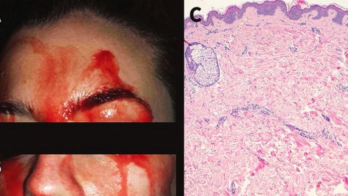 l agghiacciante caso delle persone che sudano sangue condizione medica rara
