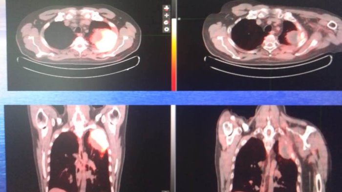 ospedale di salerno esportata in cina una nuova tecnica di radioterapia