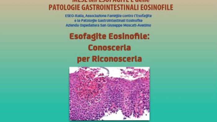 esofagite eosinofila all azienda moscati un incontro per conoscere la malattia