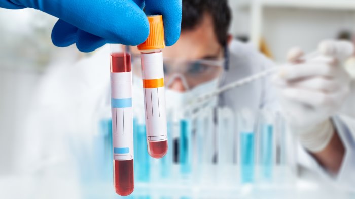 un test del sangue per diagnosticare l alzheimer la speranza diventa realta